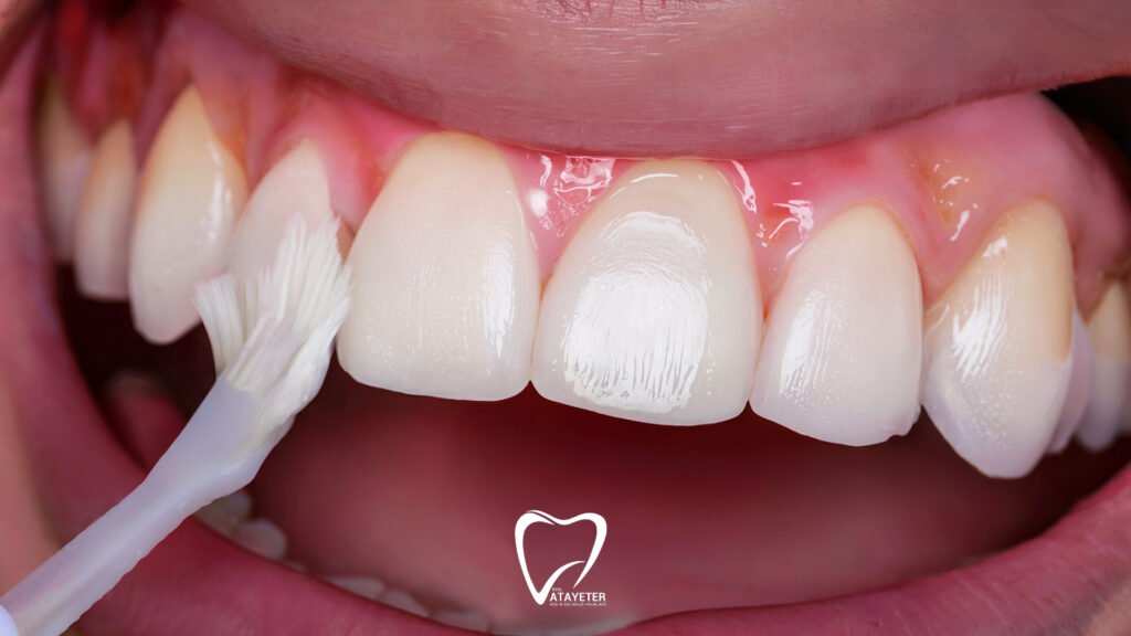 What is Fluoride Treatment