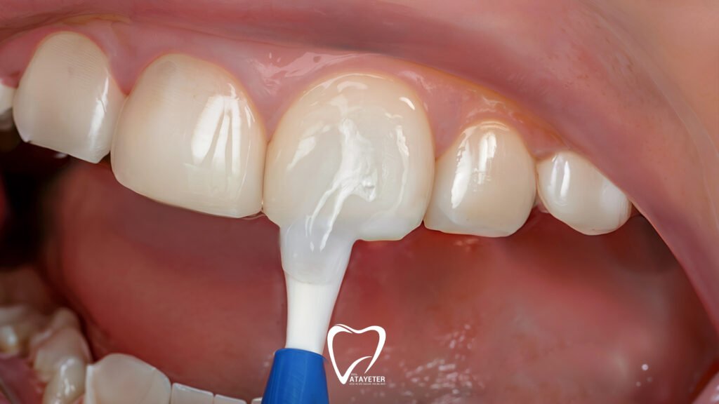 What is Fluoride Treatment