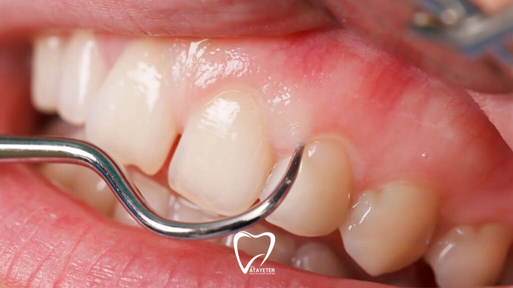 Diş Eti Kaşıntısı Nedenleri