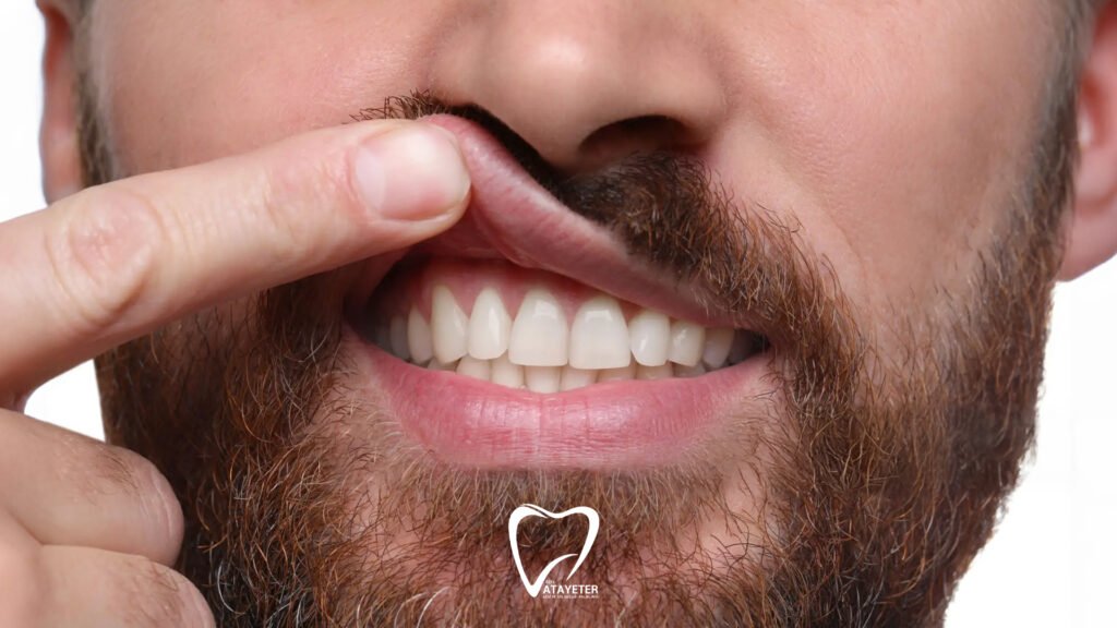 Diş Eti Kaşıntısı Nedenleri