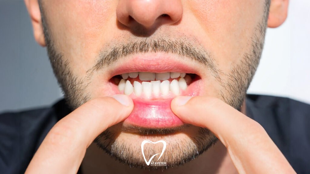 Diş Eti Kaşıntısı Nedenleri