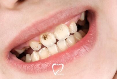 Why Do Teeth Get Stained