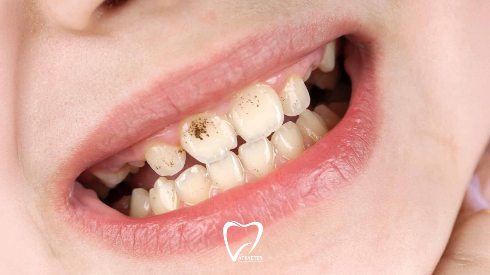 Why Do Teeth Get Stained