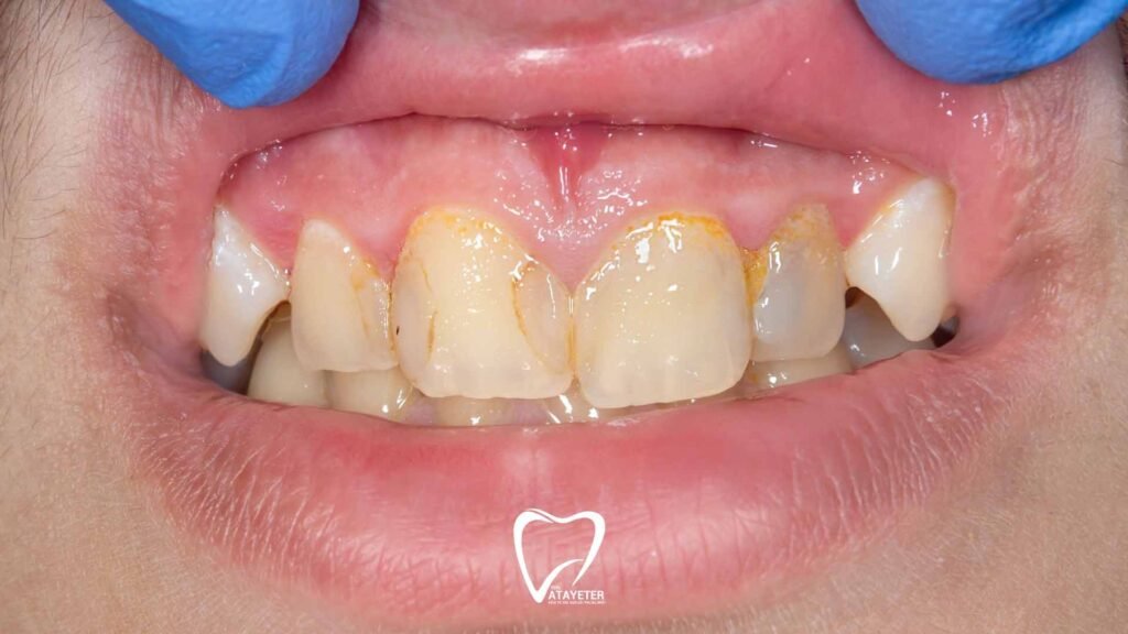 Why Do Teeth Get Stained?