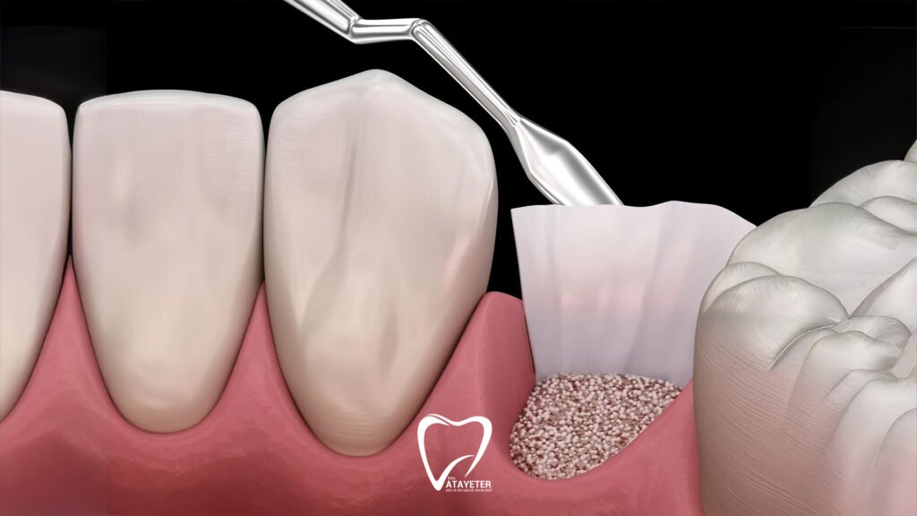 What Is a Bone Graft