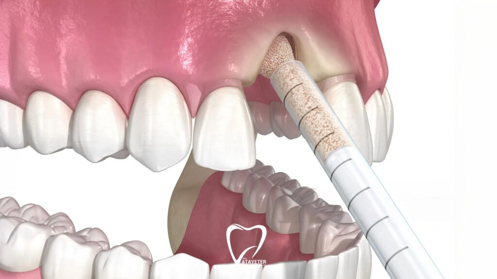 What Is a Bone Graft