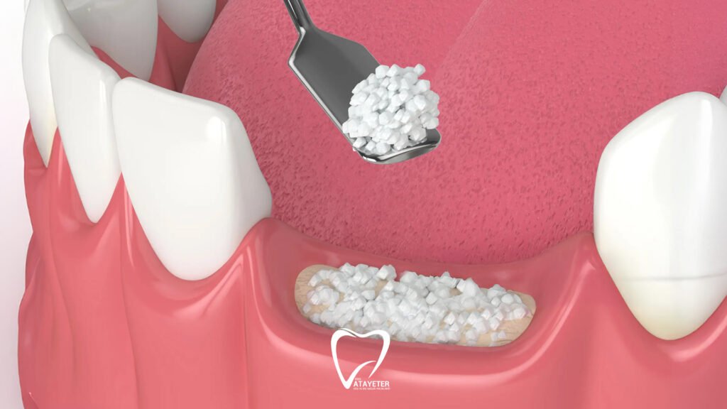 What Is a Bone Graft