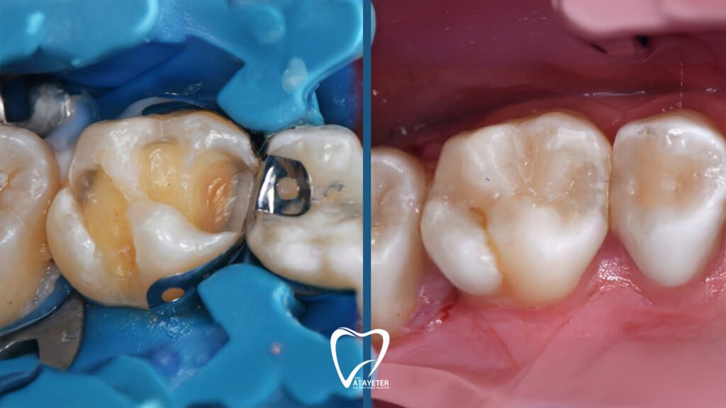 What is Pulp Capping