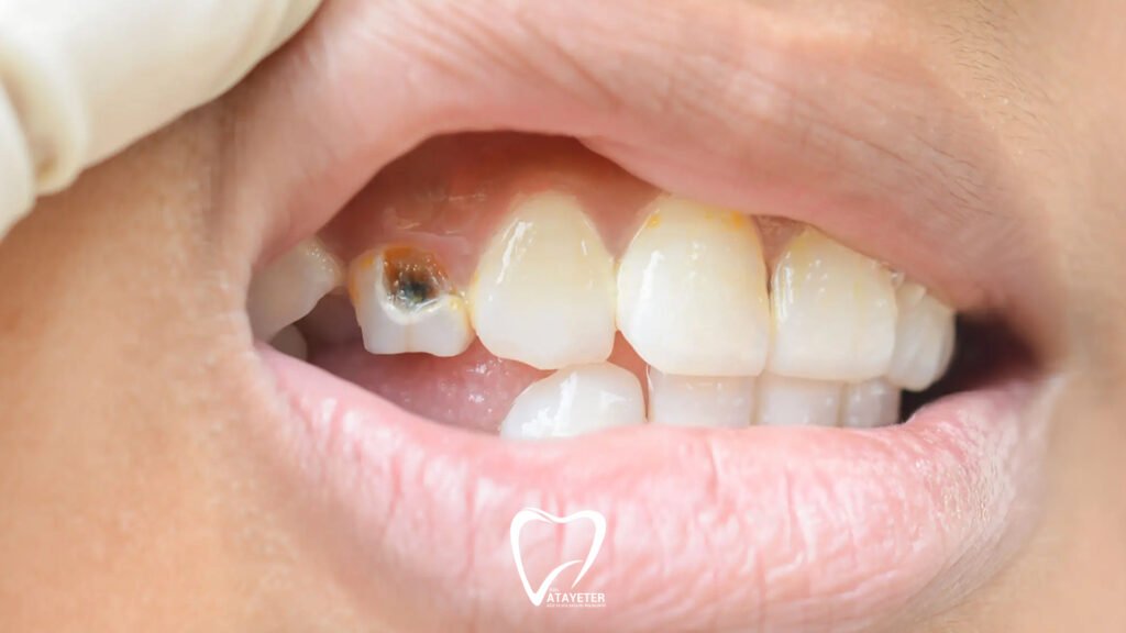 Causes of Tooth Decay