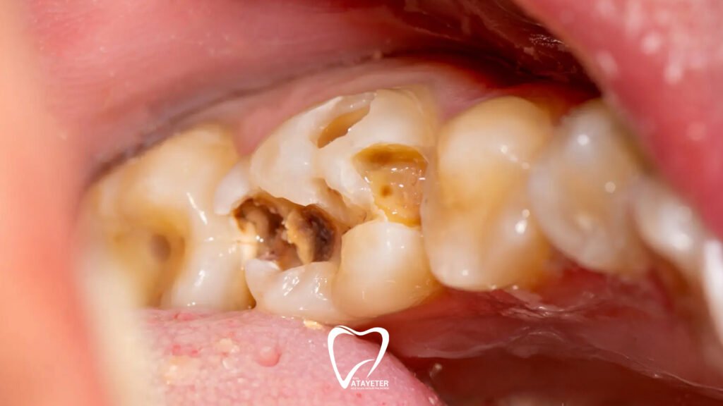 Causes of Tooth Decay