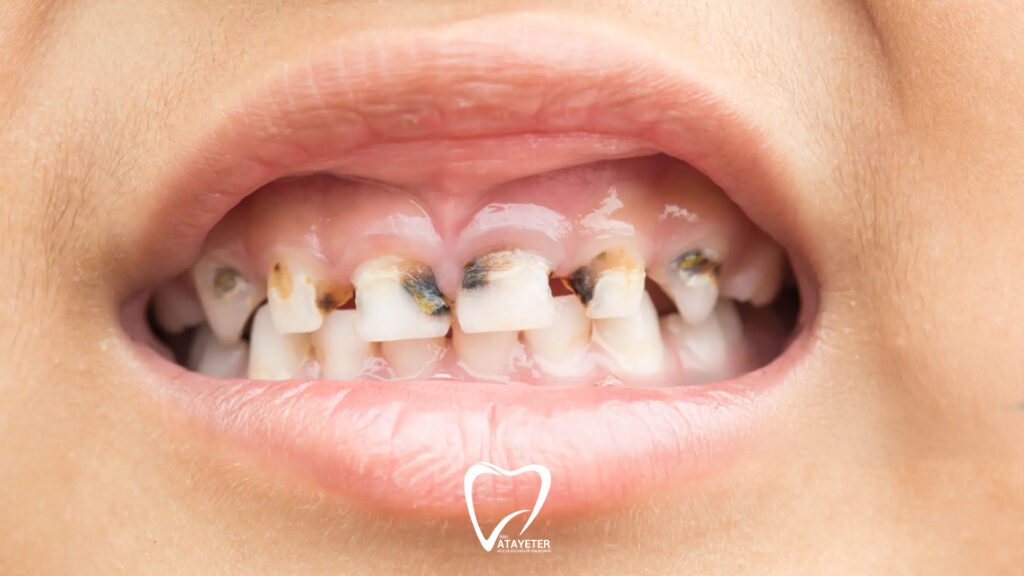 Causes of Tooth Decay