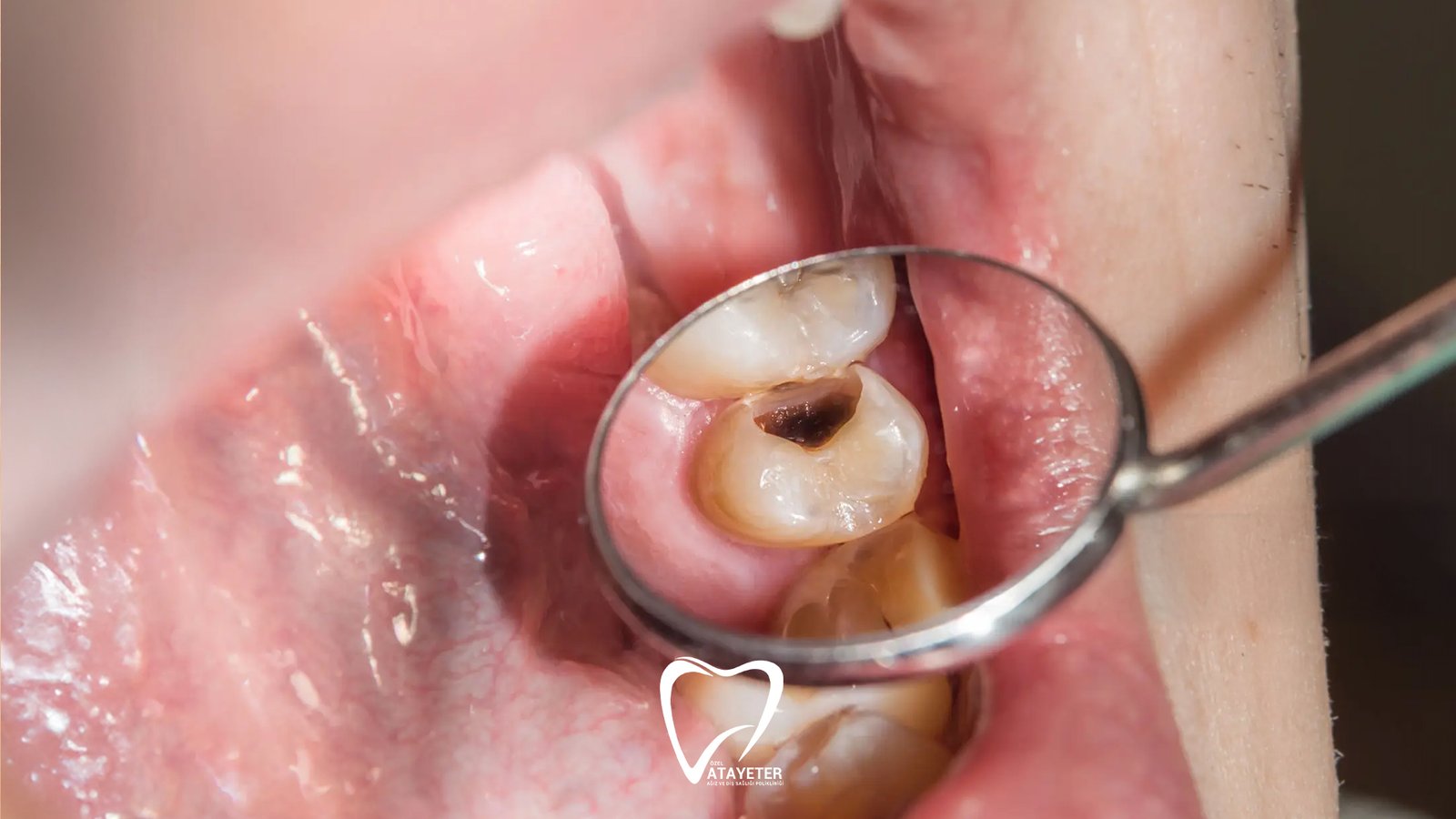 Diş Çürüğü Nedenleri