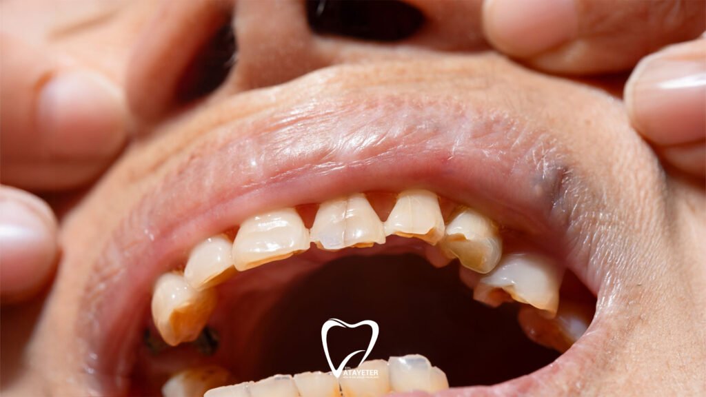 What is Tooth Erosion