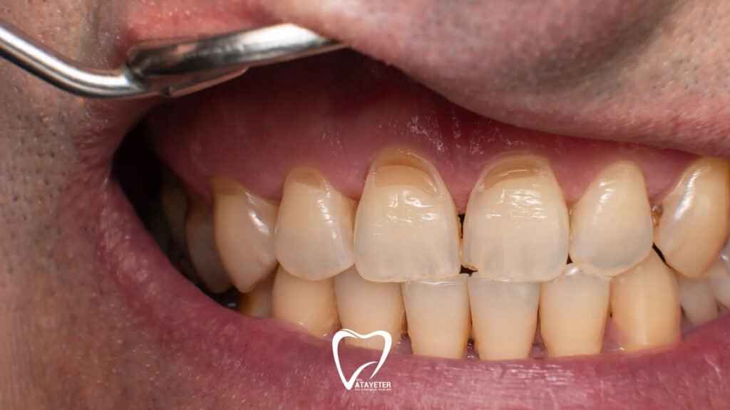 What is Tooth Erosion