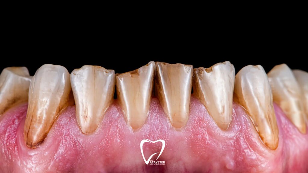 What is Tooth Erosion