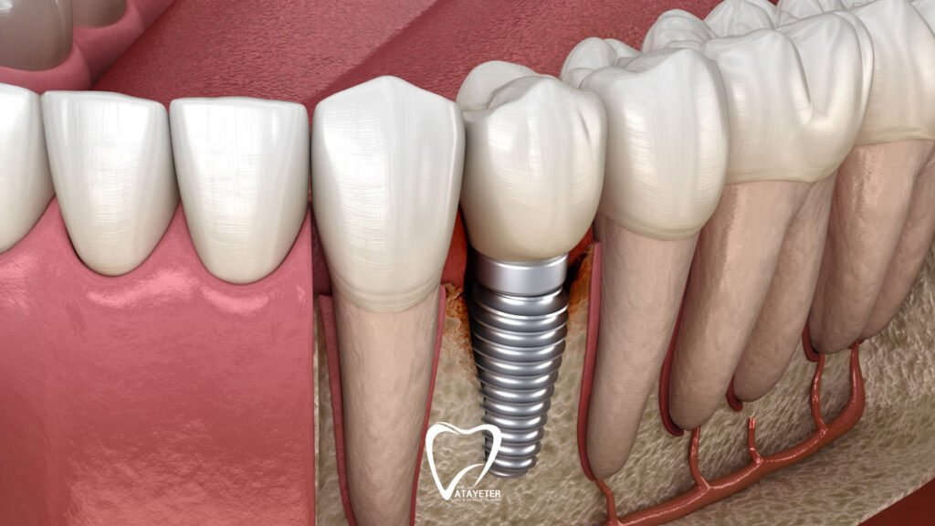 Does It Hurt After a Dental Implant