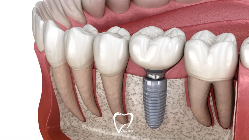 Does It Hurt After a Dental Implant