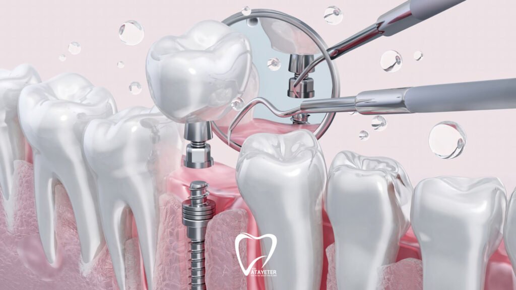 Does It Hurt After a Dental Implant