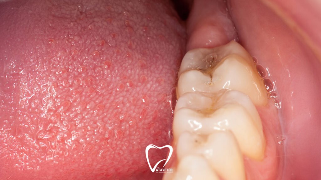 How to Relieve Wisdom Tooth Pain