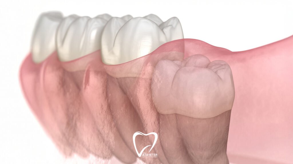 How to Relieve Wisdom Tooth Pain