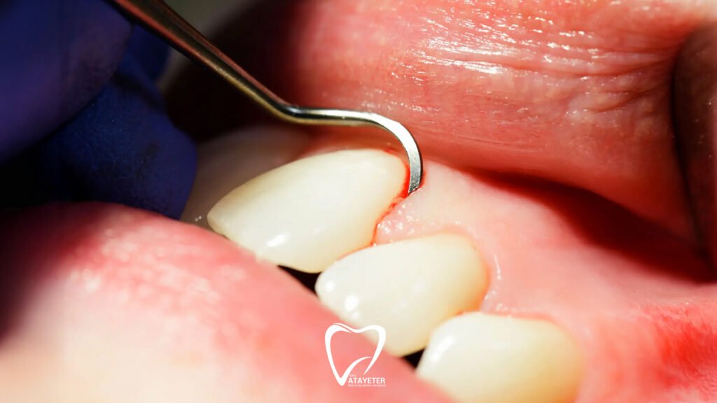 Causes of Gum Bleeding