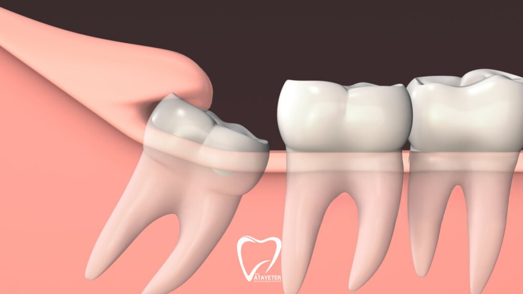 What is an Impacted Tooth?