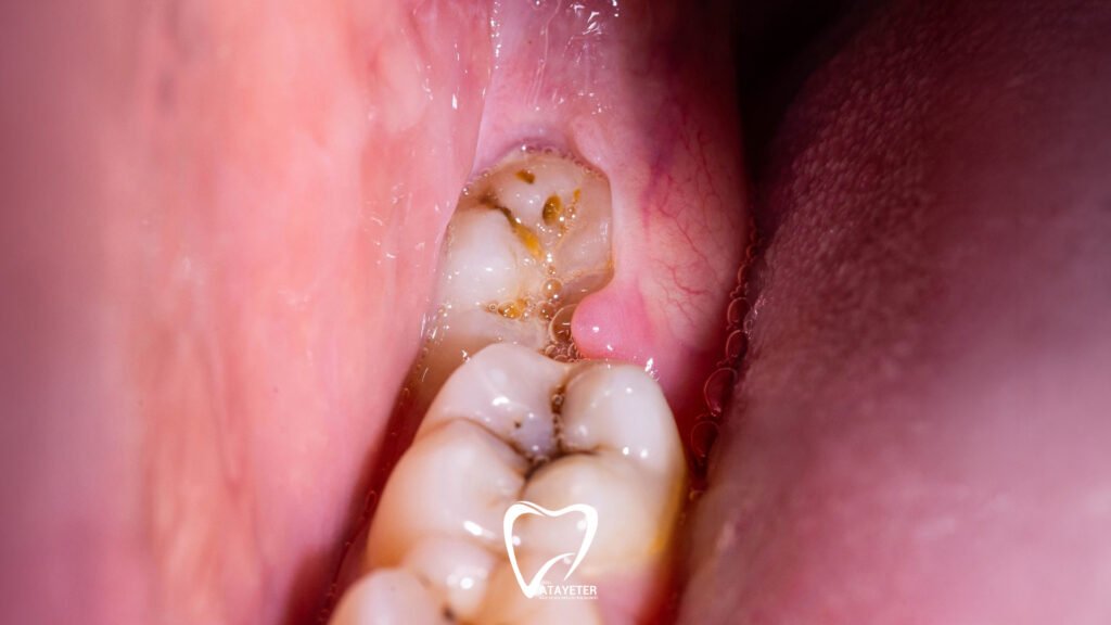 What is an Impacted Tooth?