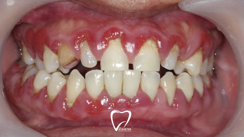 Gum Inflammation