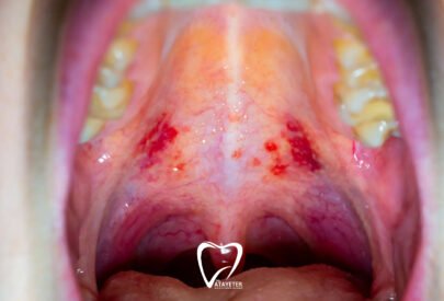 What Is a Palate Sore