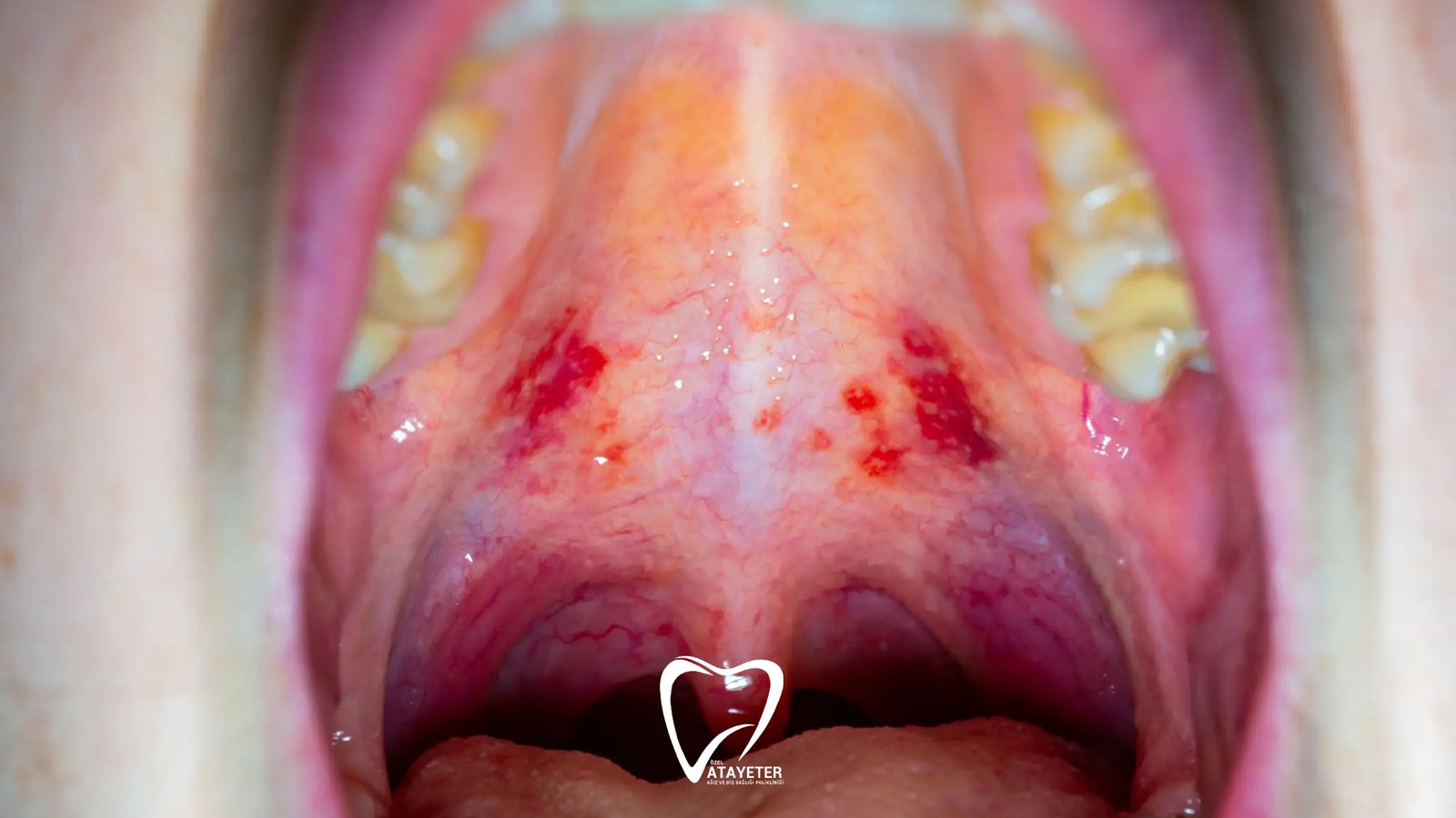 What Is a Palate Sore