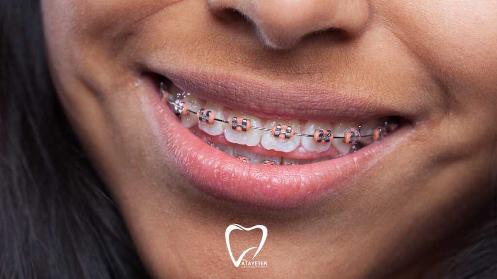 Orthodontic Treatment