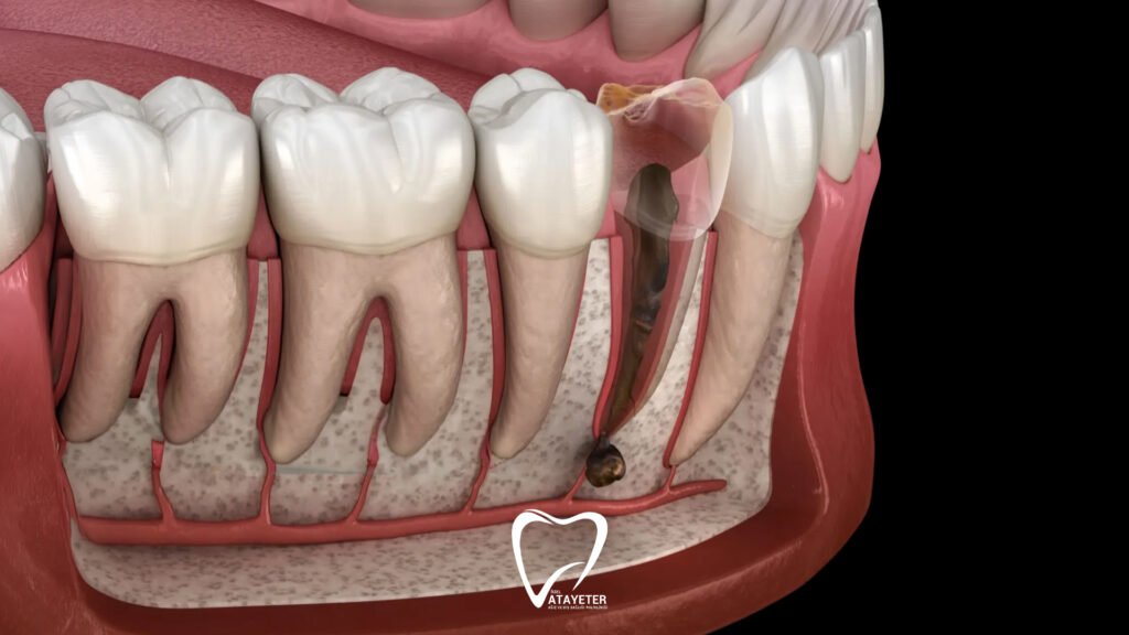What Is Apical Resection