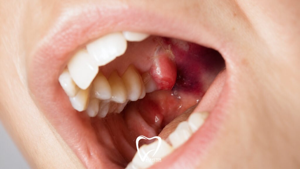 What Is a Dental Lesion