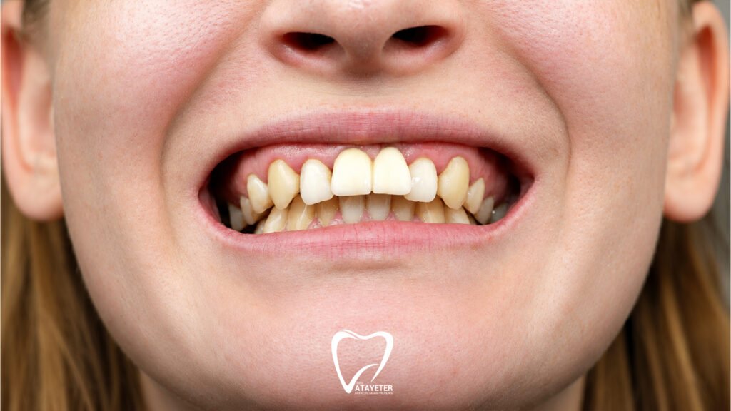 What Is Malocclusion