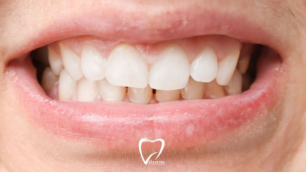What Is Malocclusion