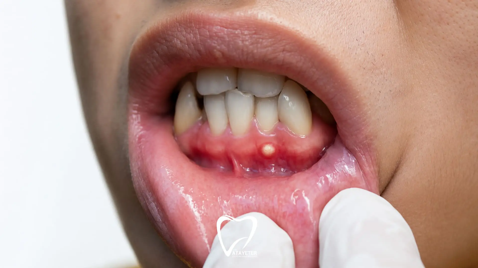 Tooth Abscess: Symptoms, Causes and Treatment