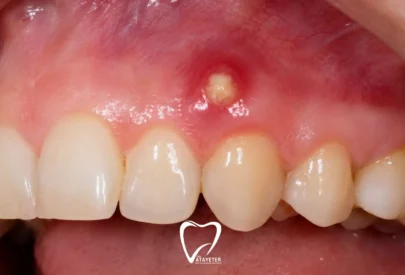 Diş Apsesi Nedir? Belirtileri Nelerdir?