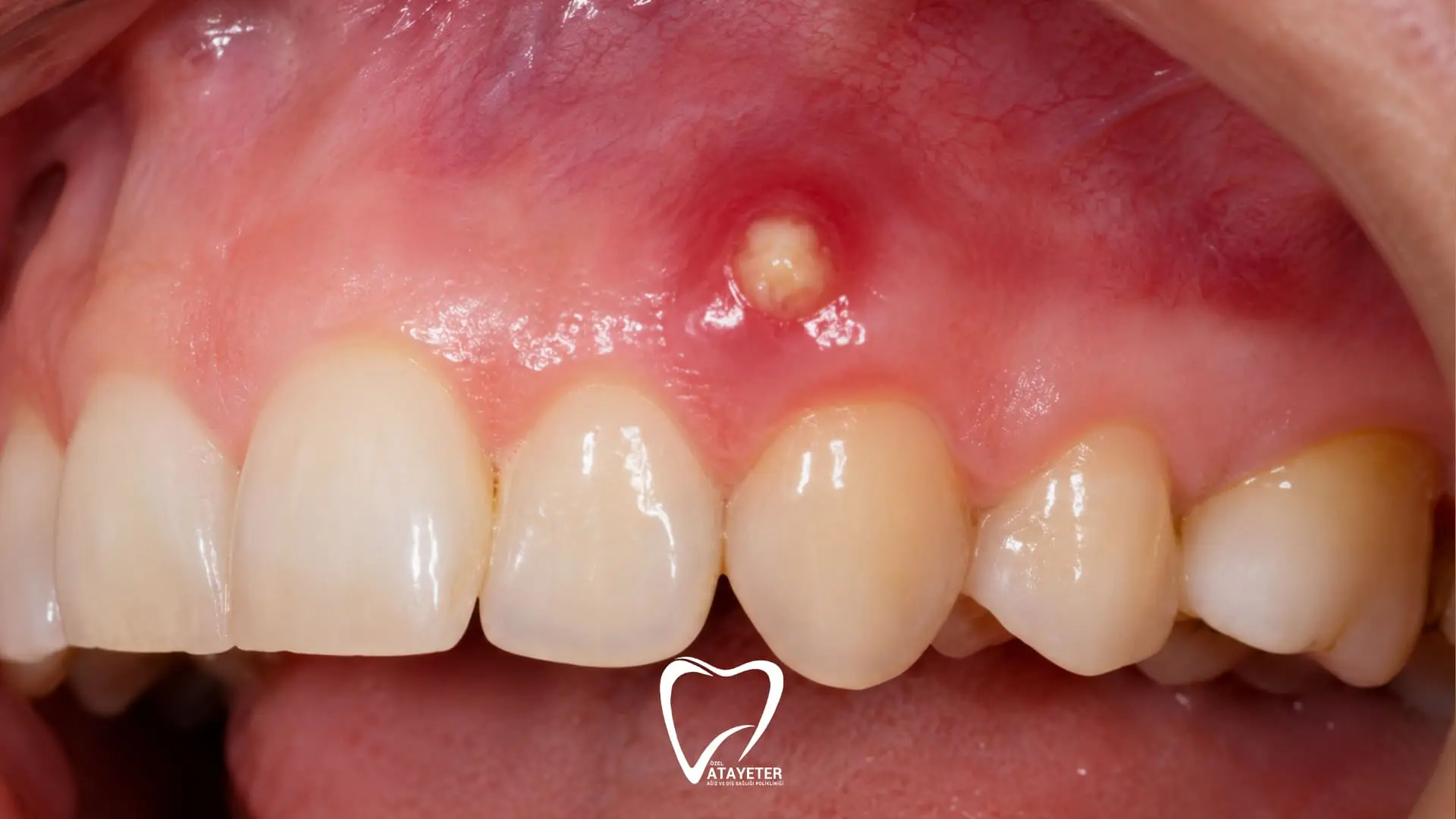 Diş Apsesi Nedir? Belirtileri Nelerdir?