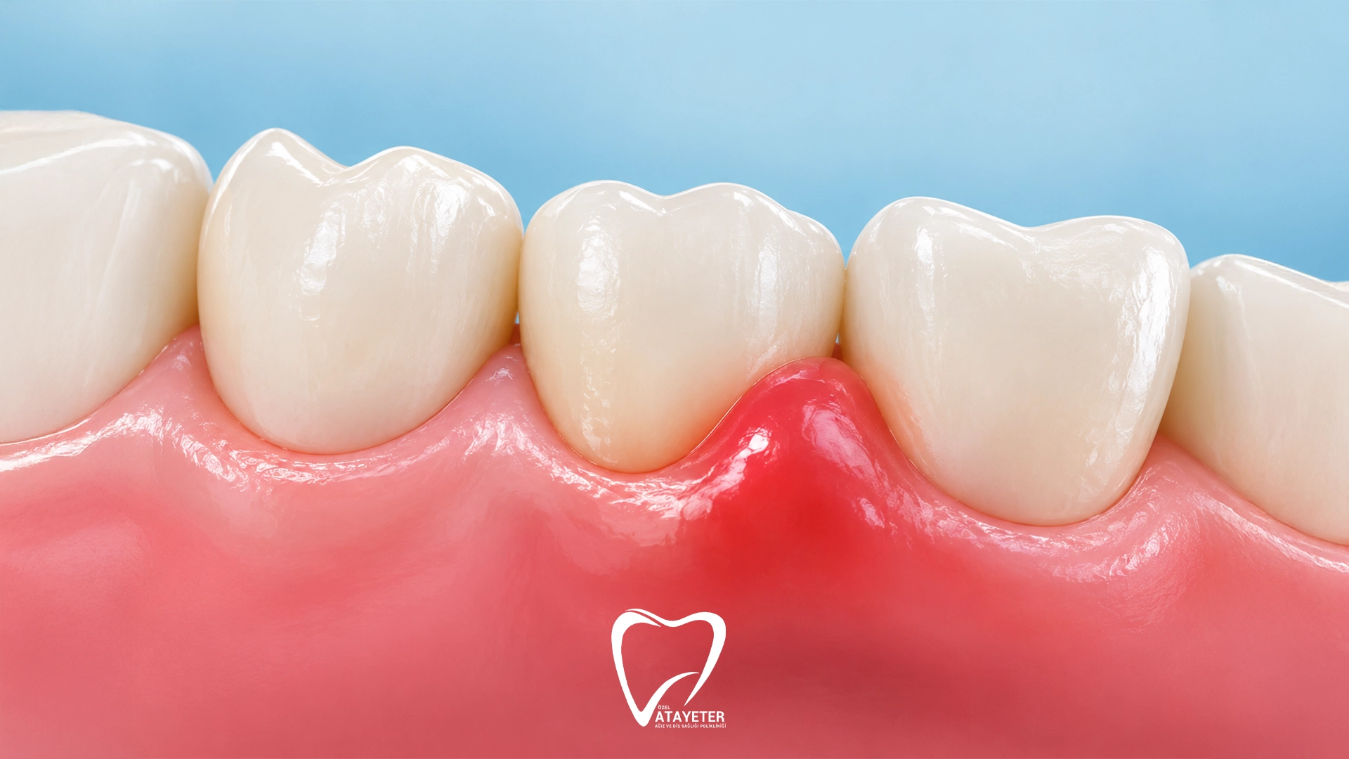 Why Are My Gums Swollen? 7 Common Causes