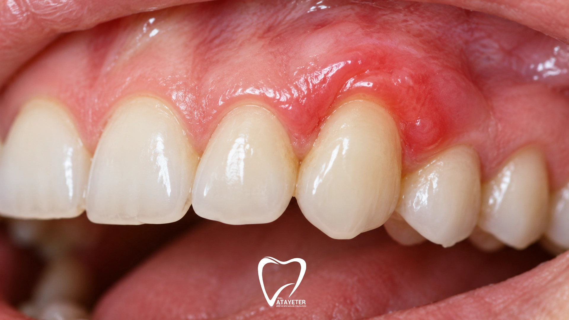 Why Are My Gums Swollen? 7 Common Causes